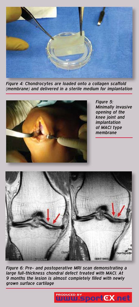 New Clinical Trial Explores How Collagen Peptides May Help Knee Osteoarthritis