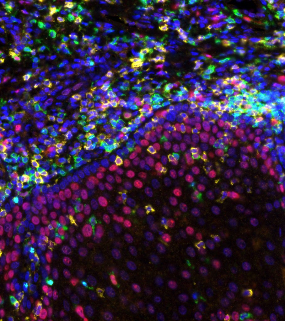 New Clinical Trial Explores Nivolumab Plus Chemotherapy for Nasopharyngeal Carcinoma
