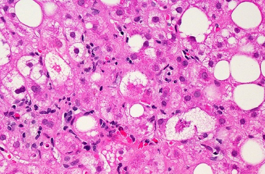 New Clinical Trial Launches to Study Efruxifermin for Advanced Liver Scarring from NASH/MASH